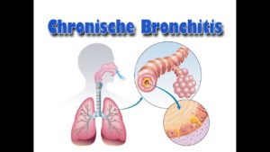 Die Grundlagen der chronischen Bronchitis verstehen – Gesundheit Aktuell